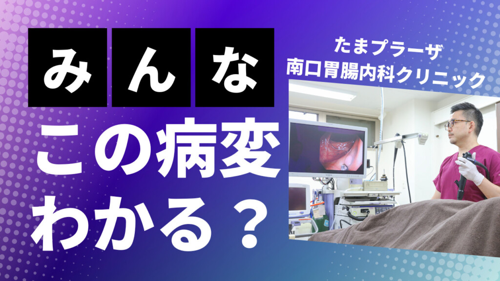 内視鏡クイズ‼この病変わかりますか？